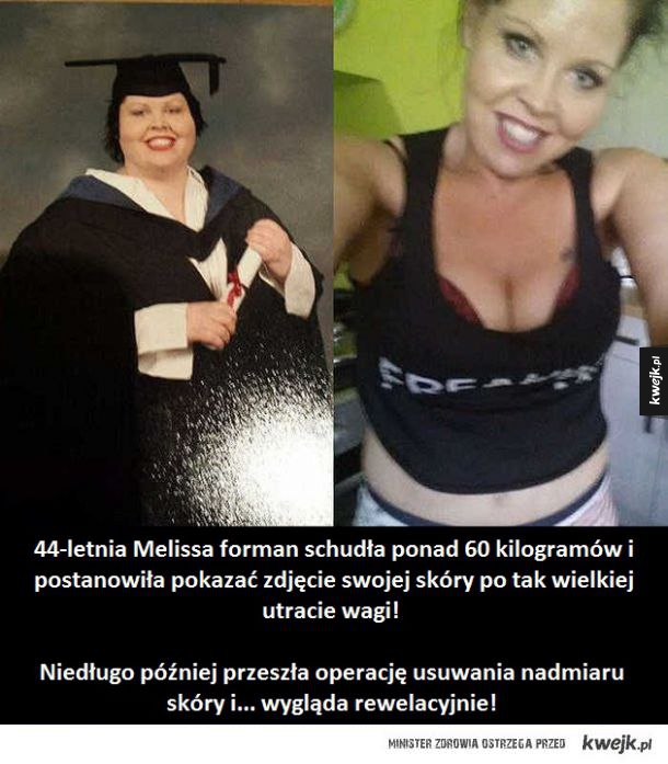 Kobieta która zrzuciła ponad 60 kilogramów pokazała swoją skórę!