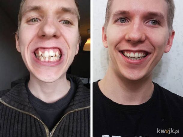 Nigdy nie przeceniaj znaczenia pięknego uśmiechu. 23 osoby, które zainwestowały w aparat ortodontyczny i dla których to była dobra decyzja