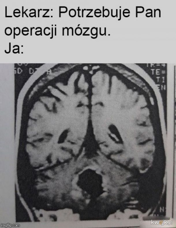Operacja mózgu